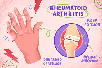 Rheumatoid Arthritis arthritis autoimmune biomedical biomedical illustration bone cartilage design disorder drawing hands health illustration inflammation joints medical pain procreate