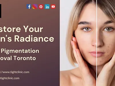 Treatment for Skin Pigmentation Removal Toronto