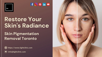 Treatment for Skin Pigmentation Removal Toronto