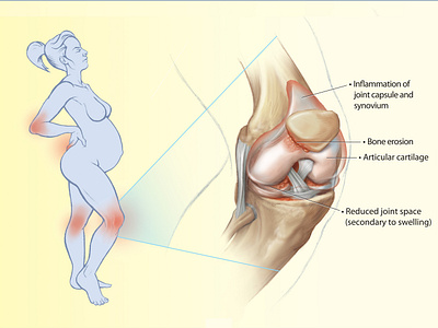 illustration for a medical research paper on maternity illustration medical medical illustration research