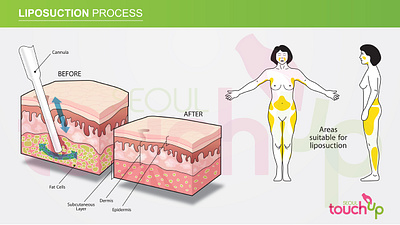 Liposuction Process Illustration illustration iluustrator liposuction