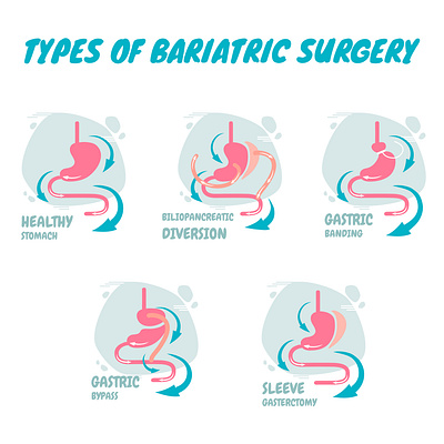 Types of bariatric surgery. digestion