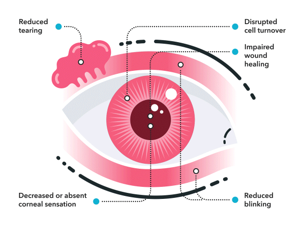 Inflammation of the eye. Medical animated infographic. 2d vector animation animated illustration eye inflammation of the eye json lottie lottie animation medical infographic svg web animation