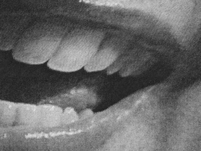 Skewed Teeth bw mouth photo scanner teeth