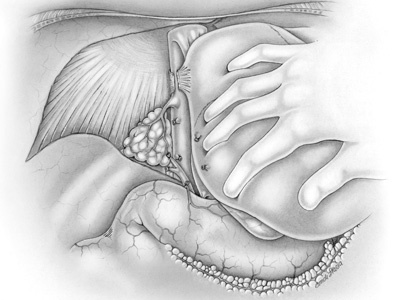 Liver Transplant airbrush liver traspant