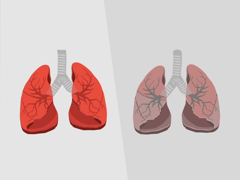 Example of WIP Lungs