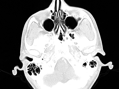 CT Scan bones ct gif jaw xray