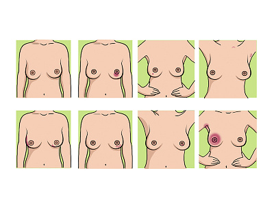 Medical Illustrations - Breast Cancer art health healthcare illustrations medical