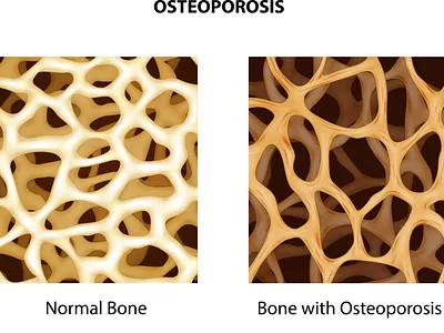 Osteoporosis anatomical anatomy arthritis bone brittle calcium disease femur fracture human illustration inflammation joint medical normal organ orthopedic osteoporosis porous rheumatism
