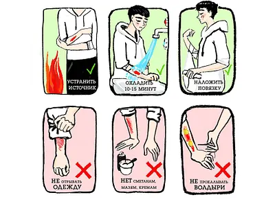 The burn illustration