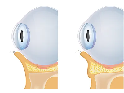 illustration about normal eye contrast bags under eyes