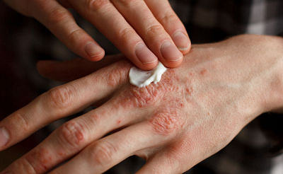 skin diseases