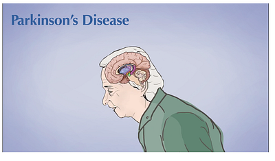 Parkinson's Disease Animation Shot 2d animation 2d art 2danimation aftereffects animaton biology brain disease elderly illustration informative line art lineart linework neurological research scientific illustration