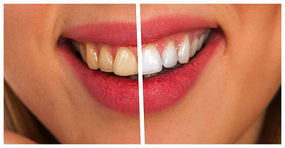 Is CleanT uSmile Pro real or a scam?