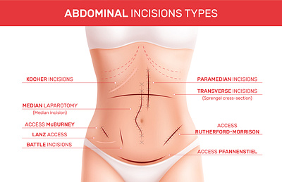 Abdominal incision types abdominal healthcare illustration incision realistic vector