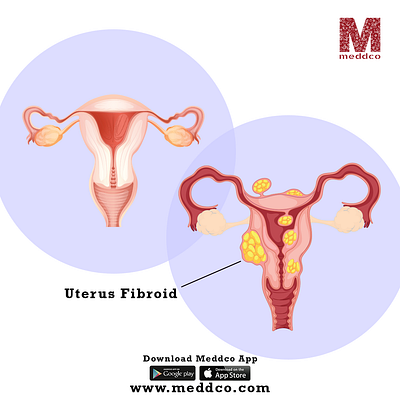 uterus fibroid entdoctor entspecialist