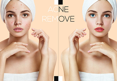 Acne remove