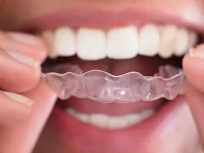 Invisalign