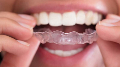 Invisalign