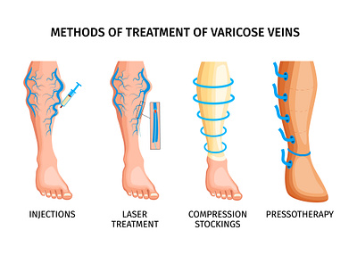 Treatment of varicose veins illustration realistic treatment varicose vector veins
