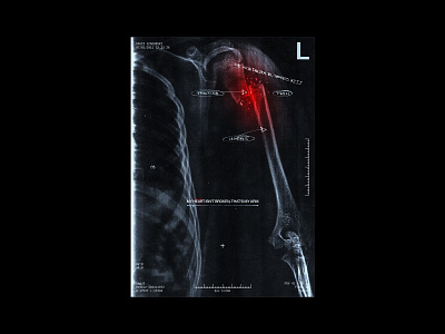 MY HEART ISN'T BROKEN, THAT'S MY ARM bone bone broke design graphic design grunge humerus layout poster poster collection print scan xray