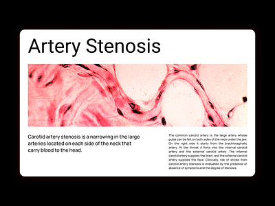 Artery Stenosis