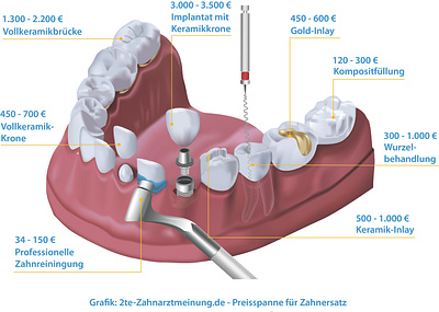 Dental treatment procedure illustration buccal dental design illustration procedure teeths tooth treatment