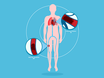 Medical Pulmonary Embolism Illustration blood clot design dvt illustration illustrator medical illustration medtech design pulmonary embolism website illustration