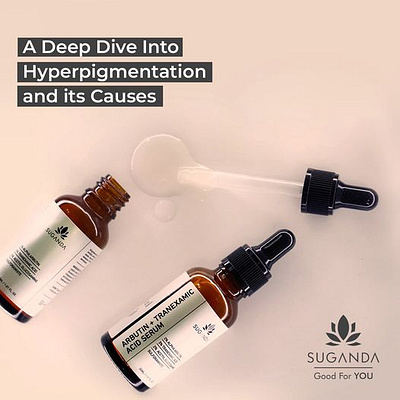 Hyperpigmentation Face Serum | Reduces pigmentation On Face. acne oily skin products skincare