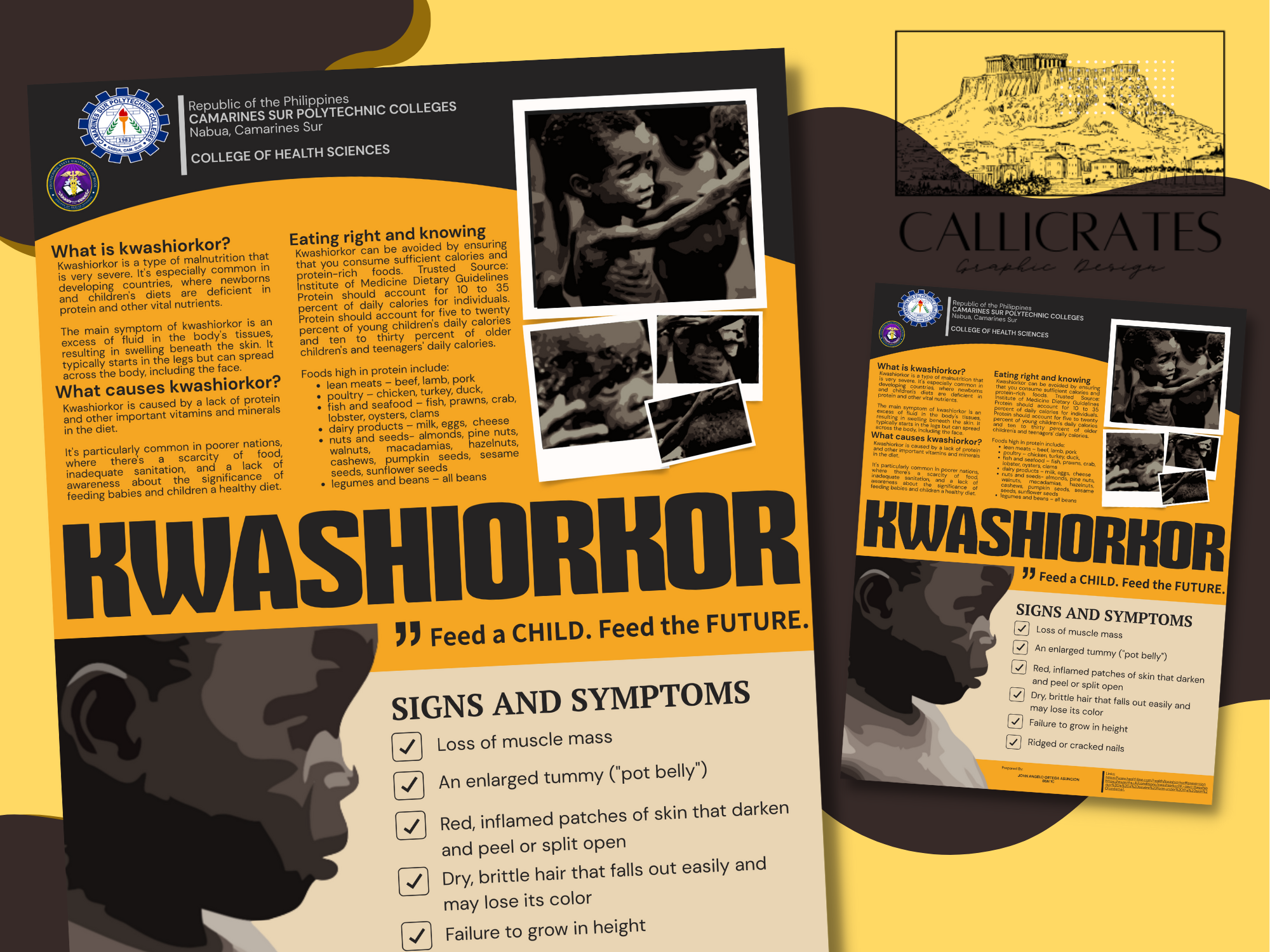 Example of Kwashiorkor