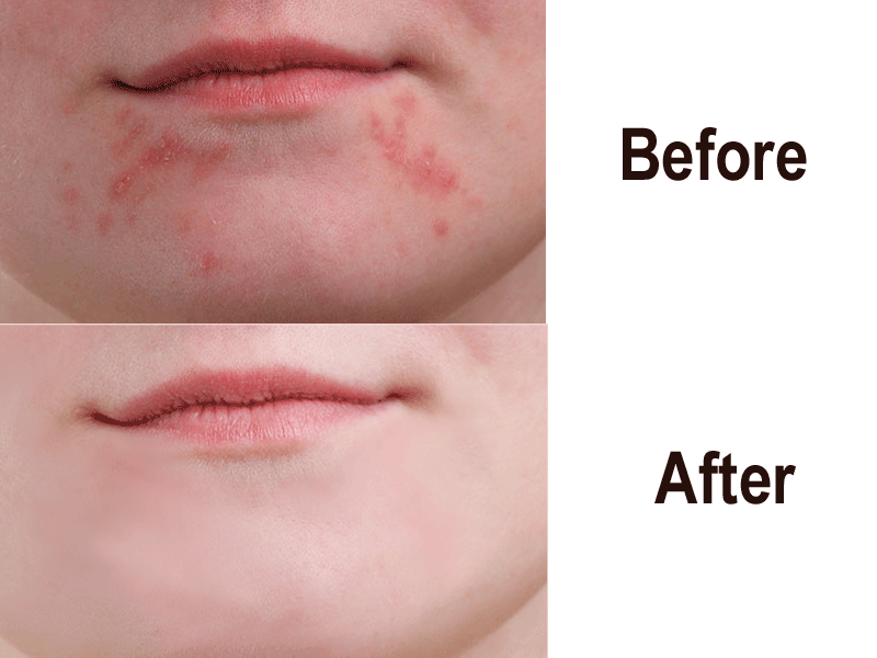 Pimple Remover on Adobe-Photoshop 3d animation graphic design logo motion graphics ui