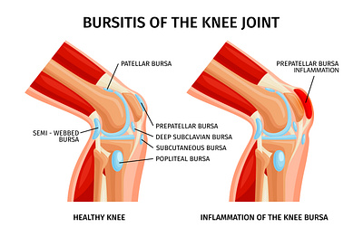 Bursitis of knee infographics anatomy bursitis illustration knee realistic vector