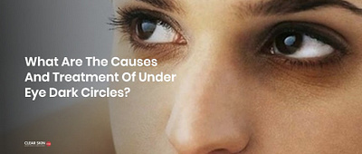 What are the causes and treatment of under eye dark circles? dark circle sensitive skin skincare under eye darkness uneven skin