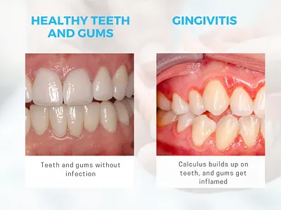 Choose Invisalign Dentist Mississauga best dentist in mississauga dental cleaning mississauga invisalign dentist mississauga root canal services mississauga root canal treatment mississauga teeth cleaning mississauga