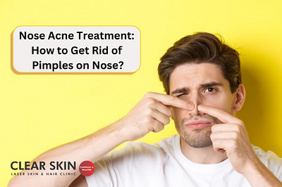 Nose Acne Treatment: How to Get Rid of Pimples on Nose? acne treatment nose acne