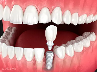 Dental Implant, abutment and ceramic crown, 3D illustration tooth