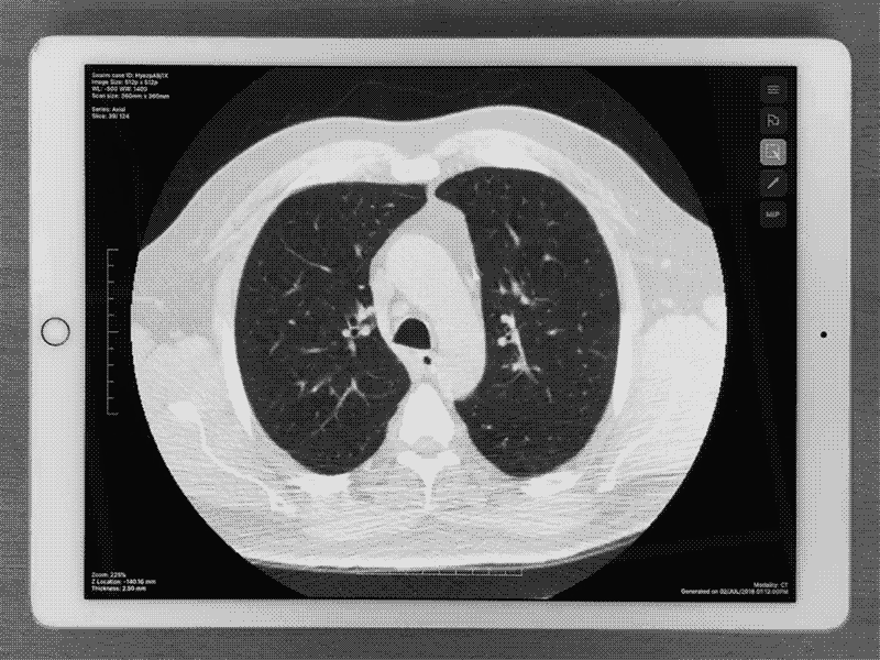 Hounsfield Measurement using iPad ai cancer ct ctscan diagnosis healthcare hospital hounsfield medical medicine medtech pacs scan