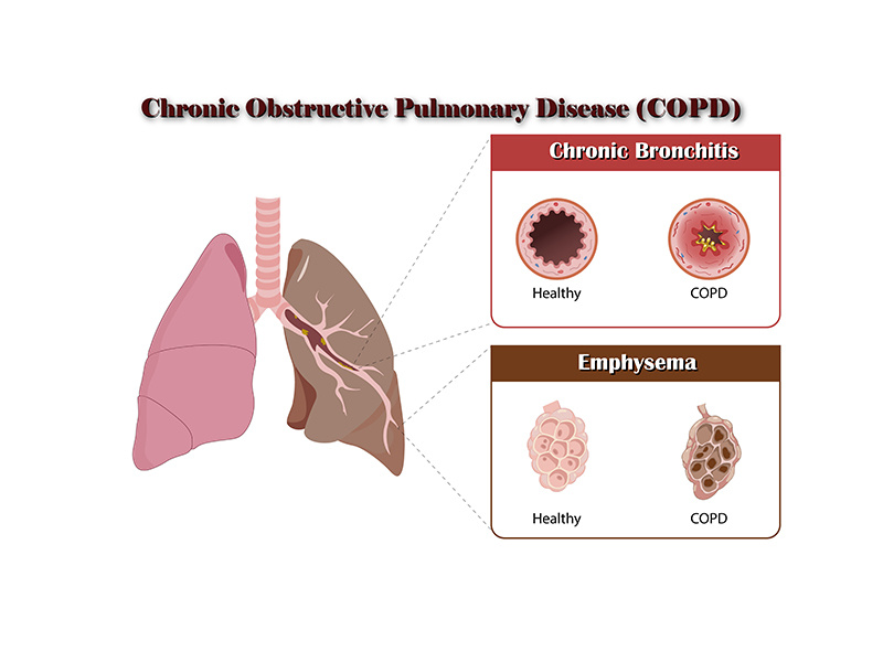 COPD Pathophysiology by Aravind Reddy Tarugu on Dribbble