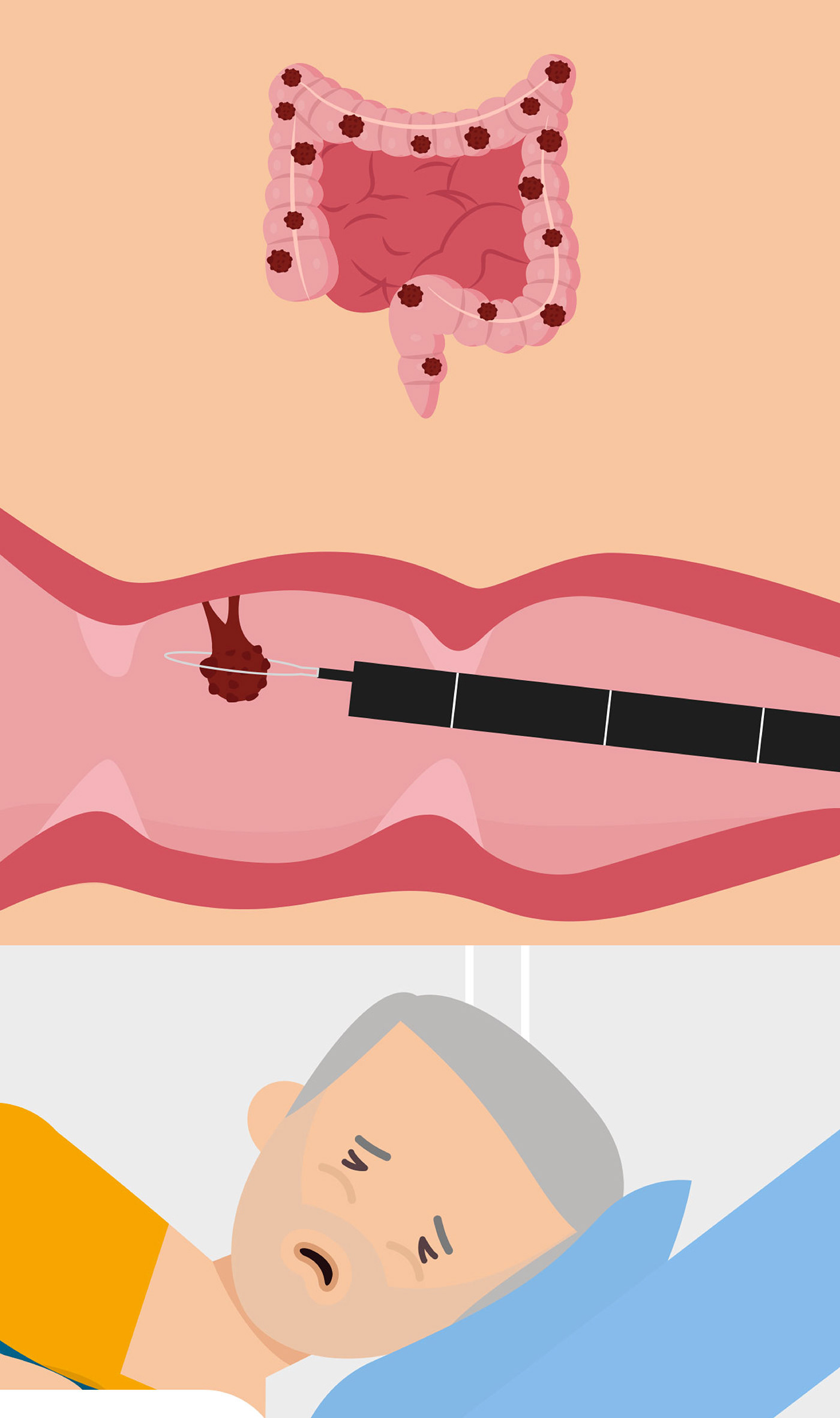 Understanding Colon Cancer Detection: A Motion Graphics Overview animation graphic design motion graphics