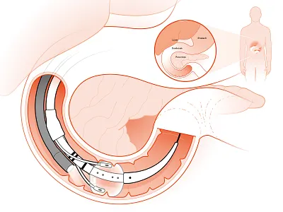 Endoscopic Duodenal Therapy Device adobe illustrator biomedical device cutaway illustration duodenum treatment endoscopic balloon endoscopy device gastrointestinal therapy healthcare healthcare illustration ieee spectrum medical illustration medical infographic medical technology minimally invasive procedure technical drawing technical graphics technical illustration vector graphics weight loss zoom