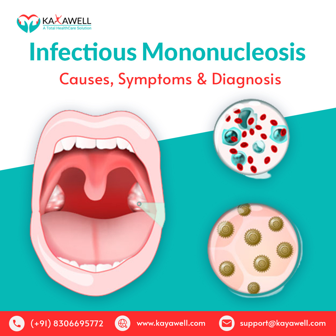Guide To Infectious Mononucleosis: Causes Symptoms & Diagnosis by ...