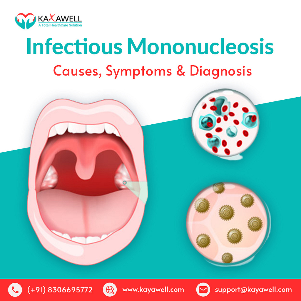 Guide To Infectious Mononucleosis: Causes Symptoms & Diagnosis by ...