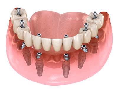 Dental protesis based on six implants 3d dental dental clinic dental illustration dentistry denture design illustration implant implantation implants prostesis render teeth tooth