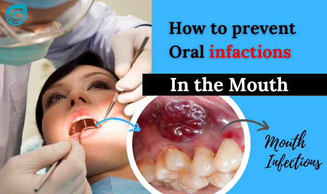 how-to-prevent-oral-infection-in-the-mouth-by-great-oral-health-on-dribbble