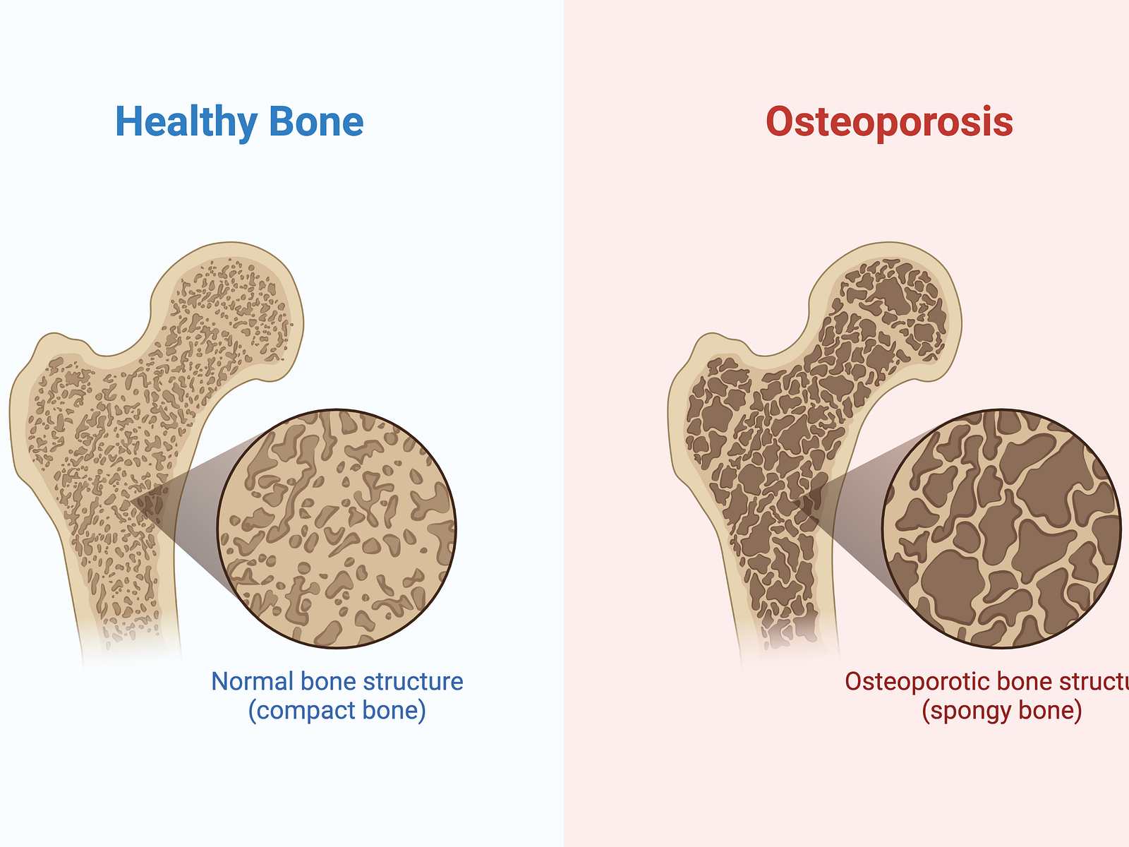 Osteoporosis by Eunice on Dribbble