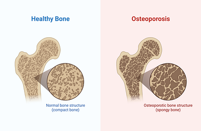 Osteoporosis biorender science design