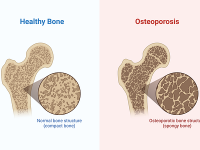 Osteoporosis biorender science design