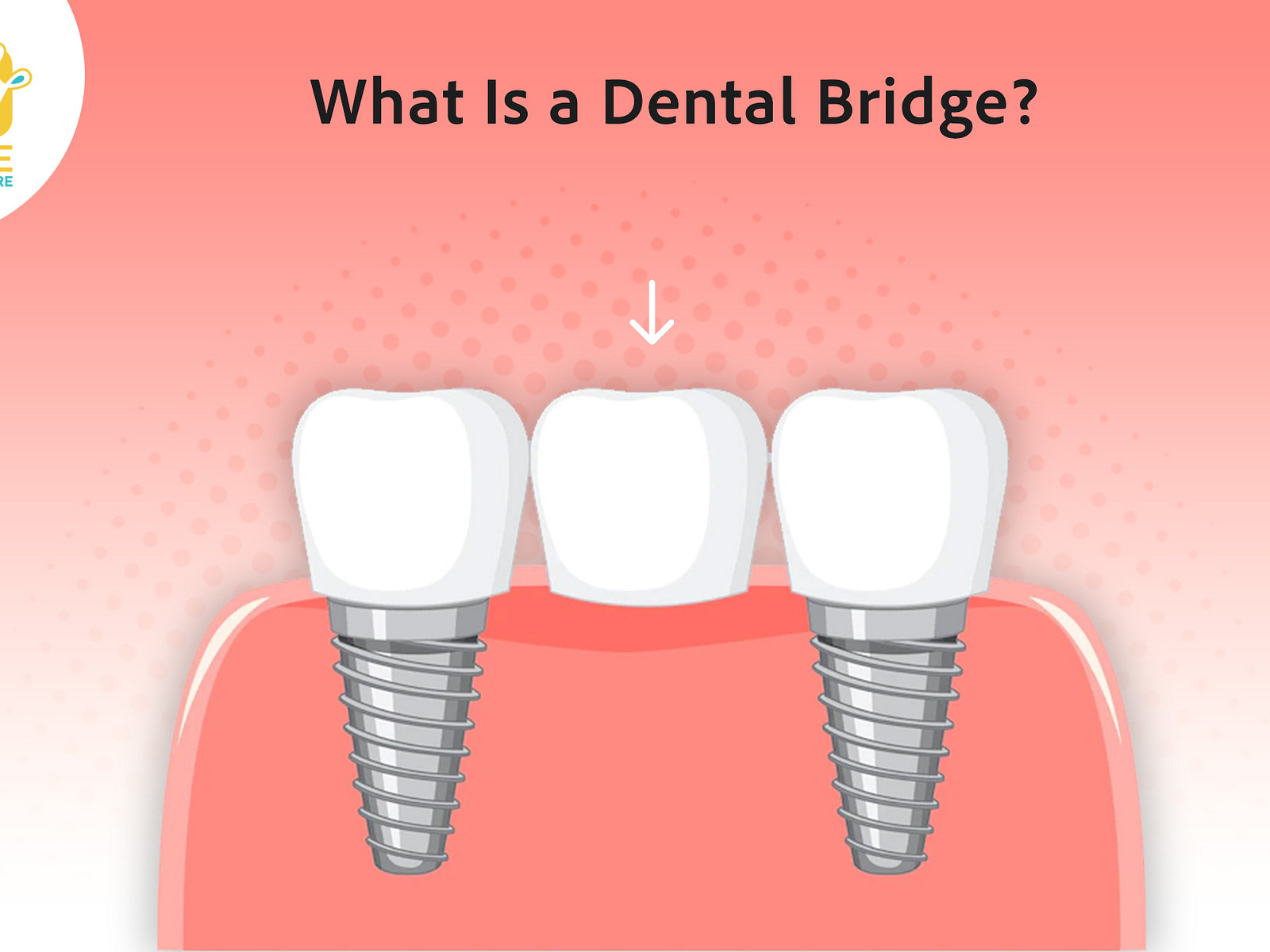 what-is-a-dental-bridge-by-elite-dental-care-on-dribbble