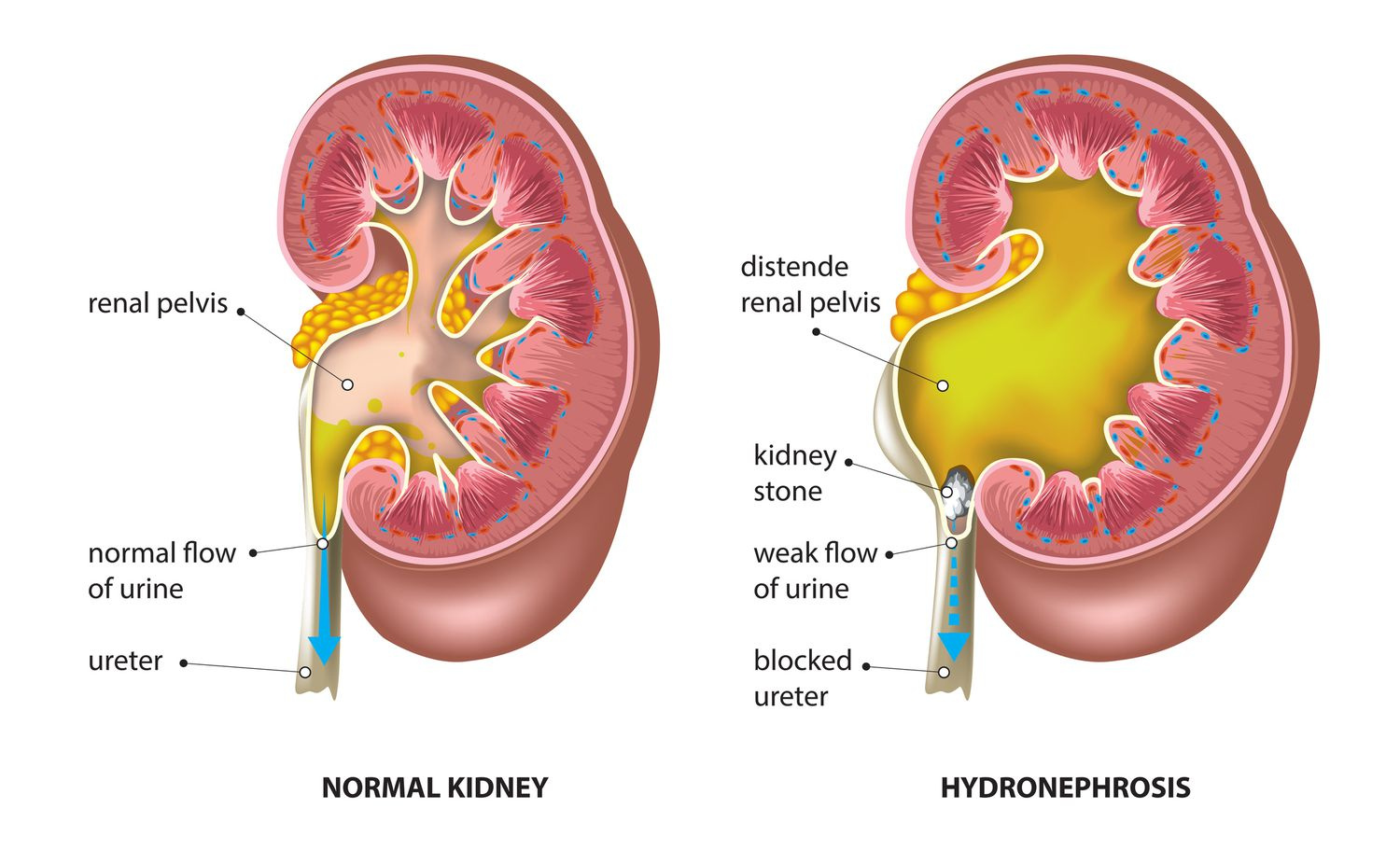 acute-kidney-failure-and-acute-glomerulonephritis-by-sachin-on-dribbble