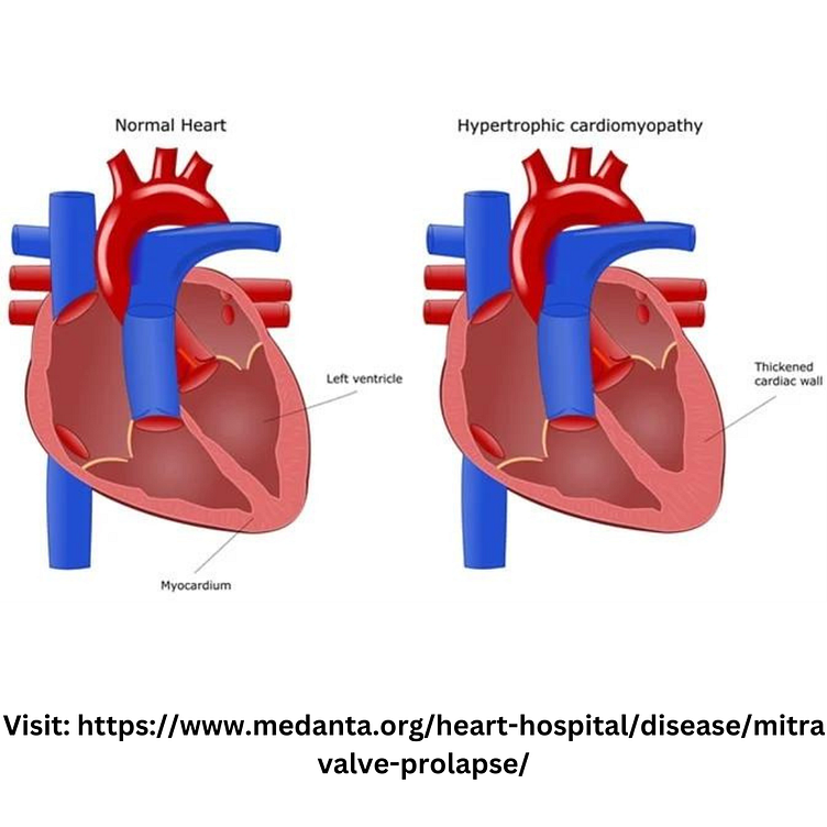 mitral-valve-prolapse-symptoms-causes-treatment-medanta-by-nidhi